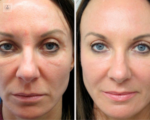 en-que-consiste-la-tecnica-del-plasma-rico-en-plaquetas-en-el-rejuvenecimiento imagen de artículo