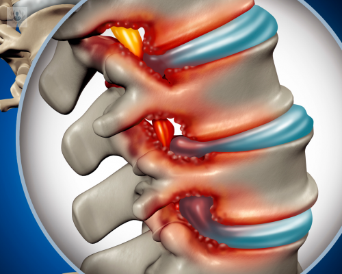 estenosis-del-canal-medular-que-es-cuando-y-por-que-aparece imagen de artículo